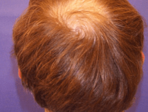 Male Pattern Hair Loss