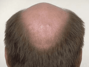 Male Pattern Hair Loss aundh