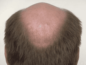 Male Pattern Hair Loss aundh