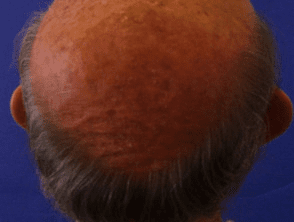 Hair Loss treatment aundh