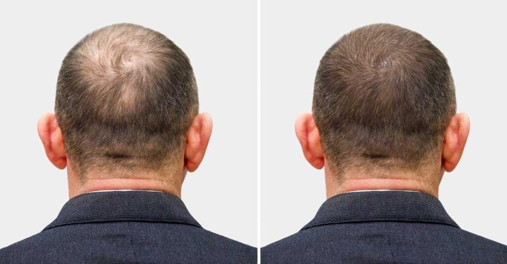 Hair Transplant Treatment in Pimple Saudagar | Pure Skin Clinic