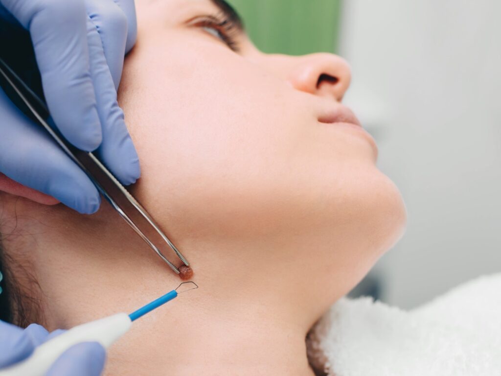Skin Tag and Mole Removal Treatment in Pimple Saudagar | Pure Skin Clinic