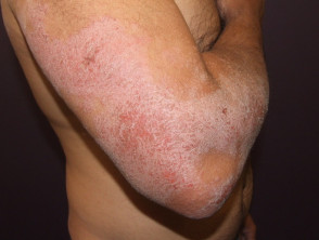 Atopic Dermatitis - Pure Skin Clinic