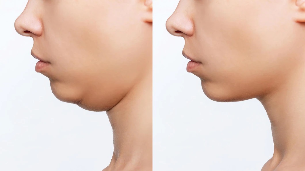 double-chin-reduction-pure-skin-clinic